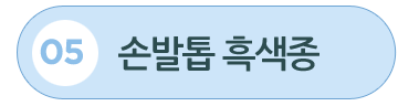 손발톱 흑색종