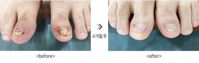 레이저 발톱무좀 시술 전후사진