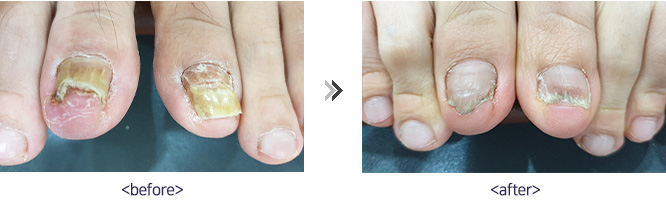 레이저 발톱무좀 시술 전후사진