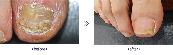 레이저 발톱무좀 시술 전후사진