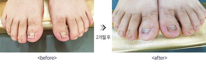 레이저 발톱무좀 시술 전후사진