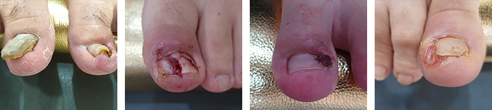 파고드는 발톱(수술법3)