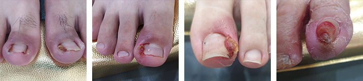 파고드는 발톱(수술법3)