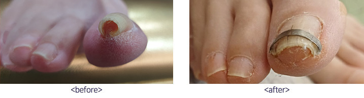 파고드는 발톱(수술법3)