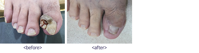 손발톱 종양 &amp; 이식술